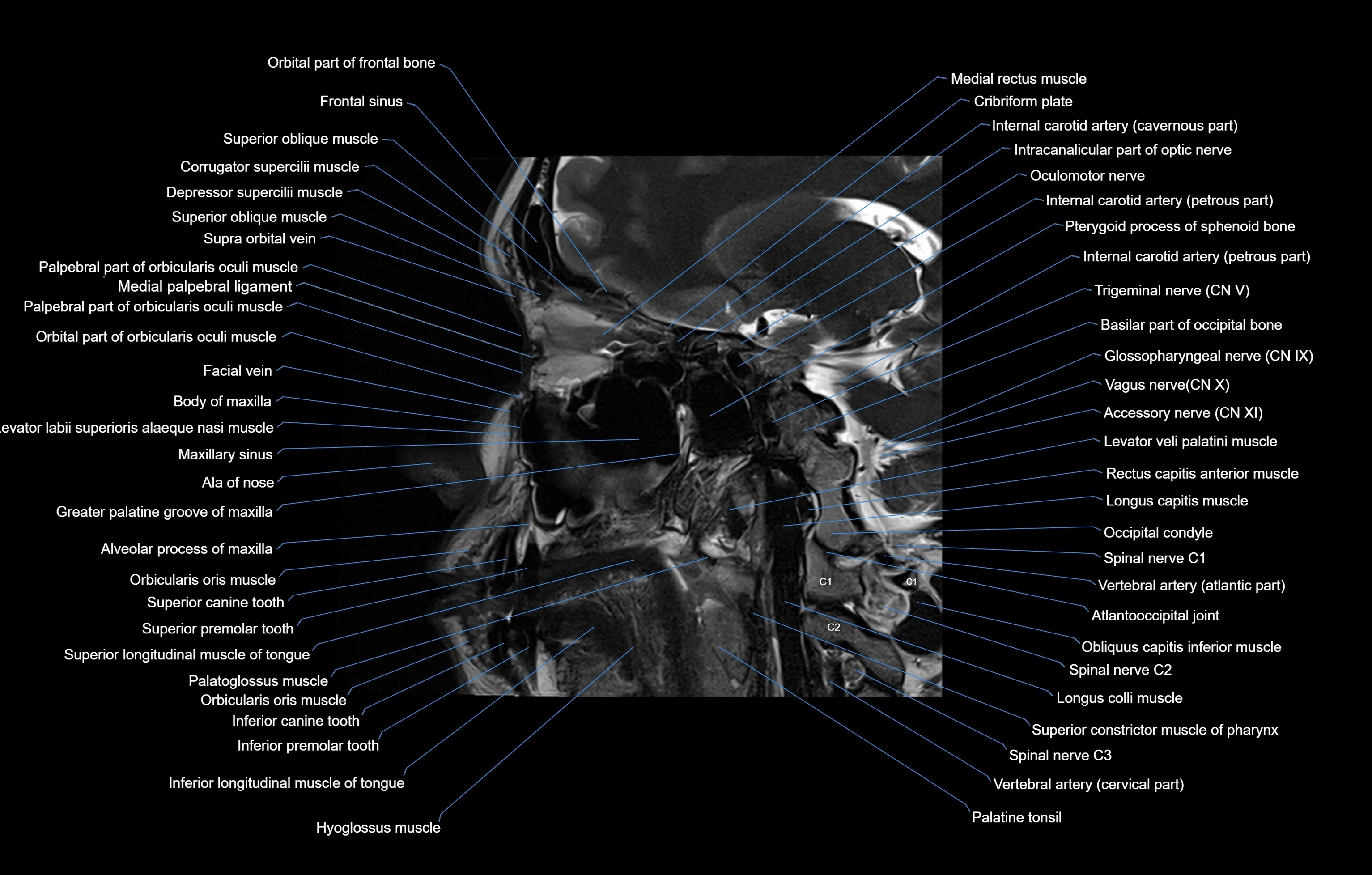 paranasal sinuses(PNS) MRI coronal  cross sectional anatomy 3T radiology  image-img-00001-00008.webp